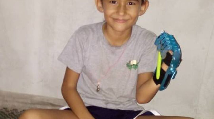 Halifax company 3-D printing prosthetics for people world wide