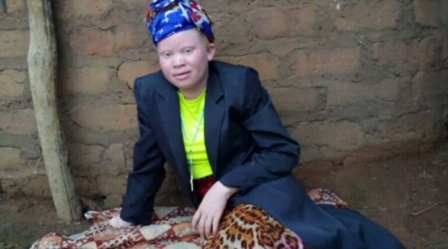 Local group raising money for albino children in Africa