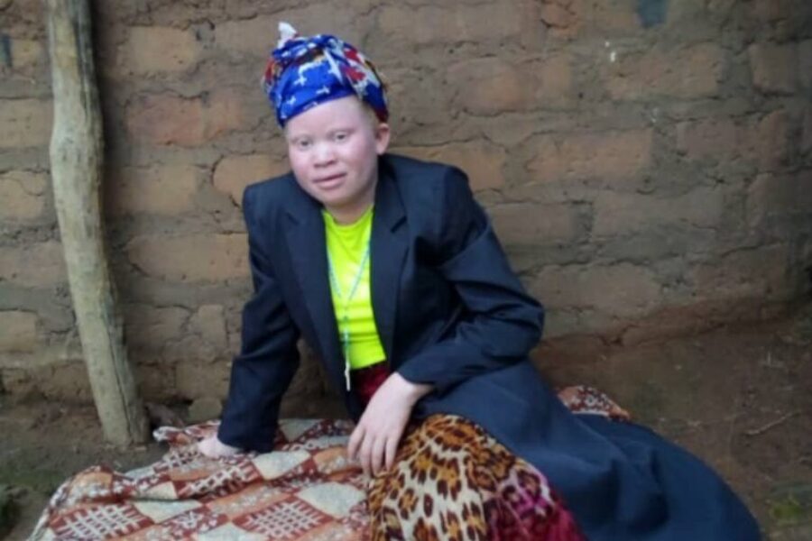Local group raising money for albino children in Africa