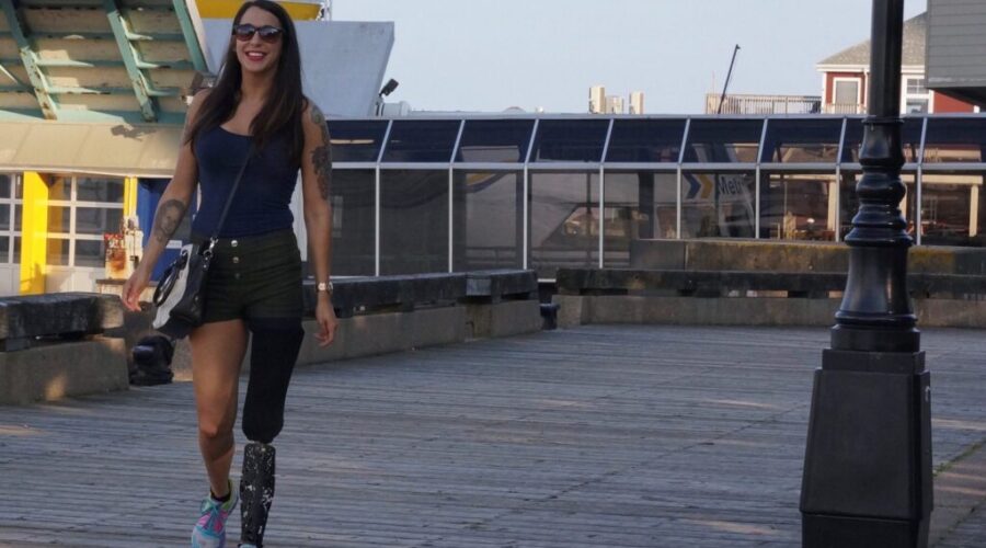 Local Woman Fundraising For New Prosthetic Leg
