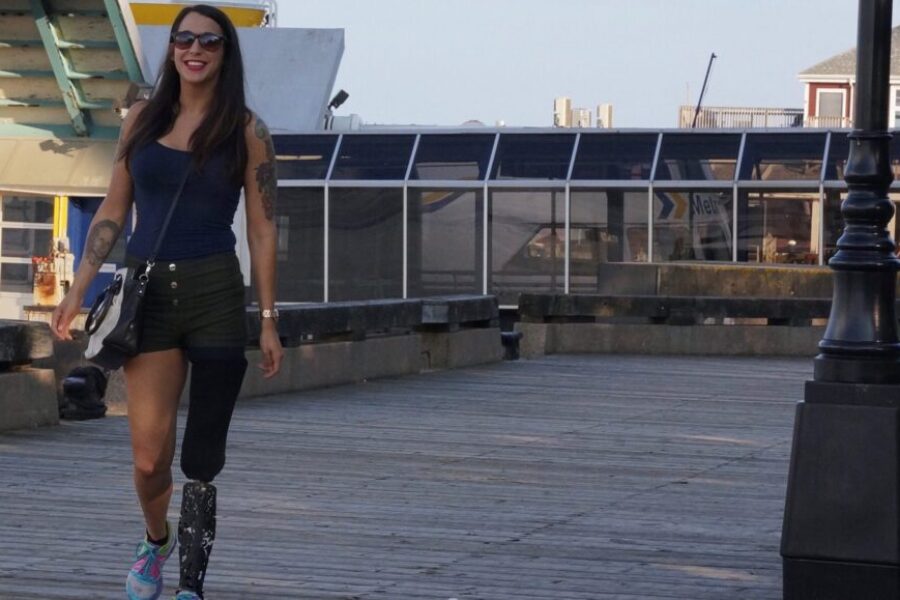 Local Woman Fundraising For New Prosthetic Leg