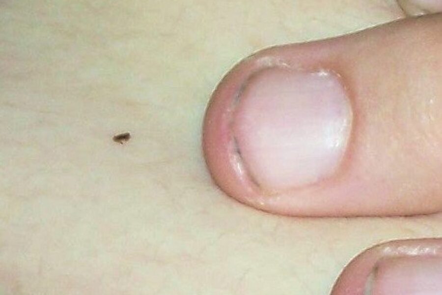 Expert suggests thorough check for ticks after outdoor adventures