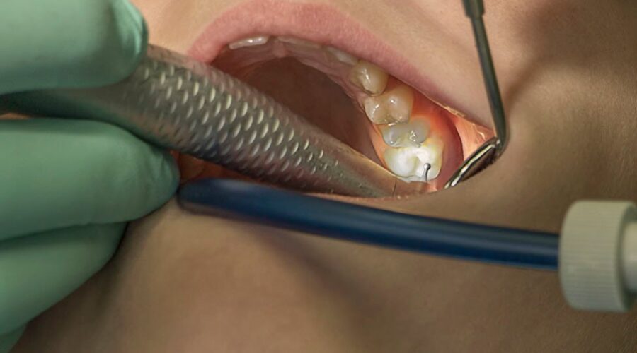 Fluoride in water is crucial for public health, says dentist