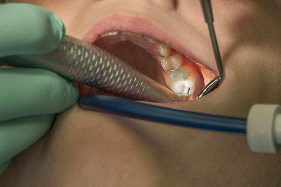 Fluoride in water is crucial for public health, says dentist