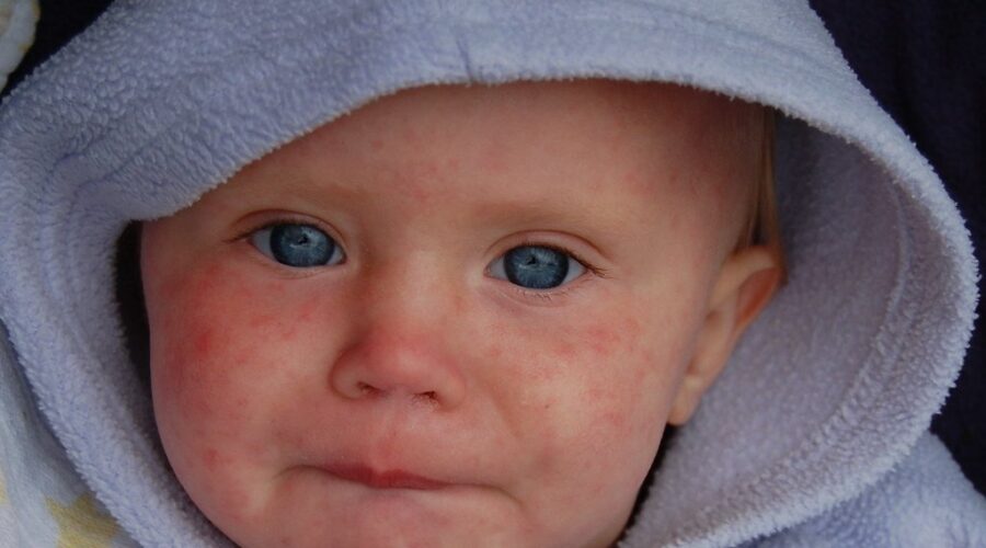 Nova Scotia measles outbreak grows to 30 cases, mostly among unvaccinated youth