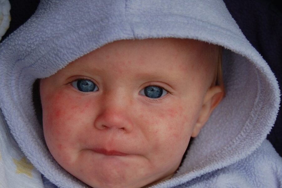 Nova Scotia measles outbreak grows to 30 cases, mostly among unvaccinated youth
