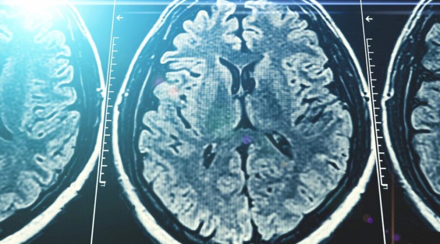 Stigma keeps many Canadians from seeking dementia help